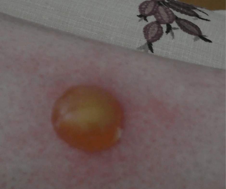 Horsefly bite fluid sac