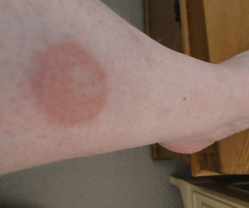 Horsefly bite site scarring